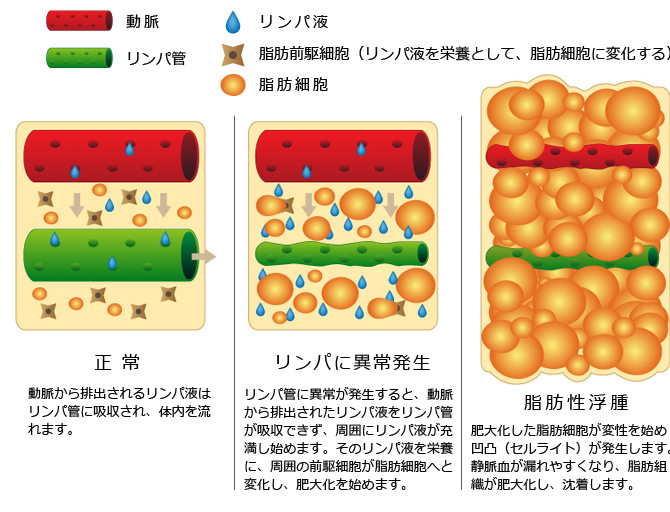 リンパ浮腫 脂肪性浮腫の改善 美容外科 ｋｕｎｏクリニック 東京銀座 大阪梅田